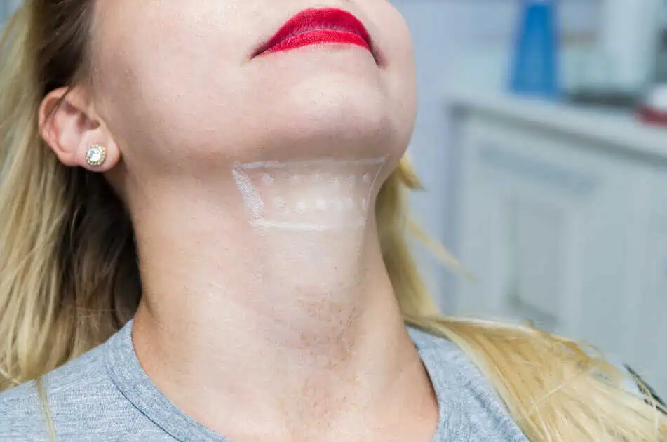 Women receiving double chin removal treatment in Mount Kisco, NY