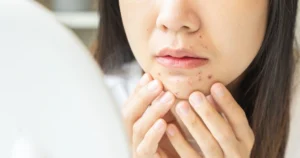Professional performing a Acne Scar Treatment with a handheld device on a clients face, illustrating advanced laser technology.